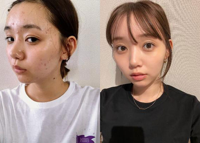 江野沢愛美がニキビに悩んだ過去を初告白、肌荒れ写真公開にも反響